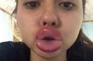 La nouvelle mode stupide pour se faire grossir les lèvres Kylie Jenner Challenge, lèvres gonflées