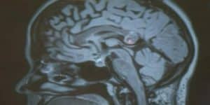 Elle a vécu pendant 26 ans avec l’embryon de son jumeau dans le cerveau Yamini Karanam, tumeur, cerveau, jumeau embryonnaire