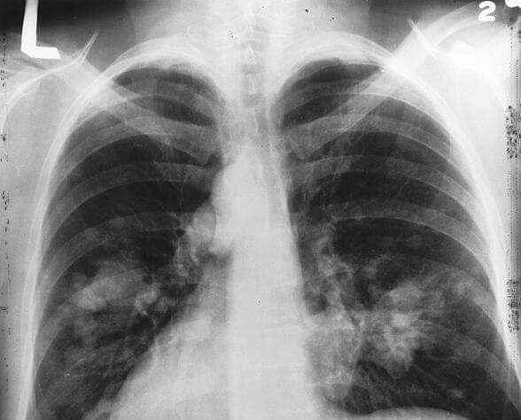 Cancer poumon Cuba