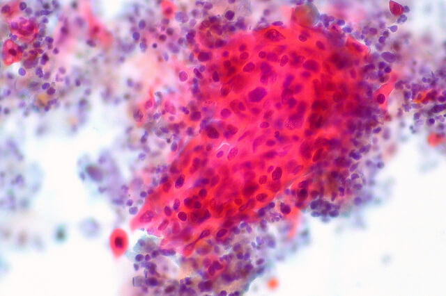 Cancer poumon Cuba
