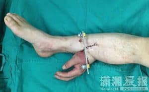 main-jambe-chirurgie