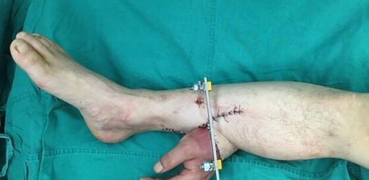 main-jambe-chirurgie