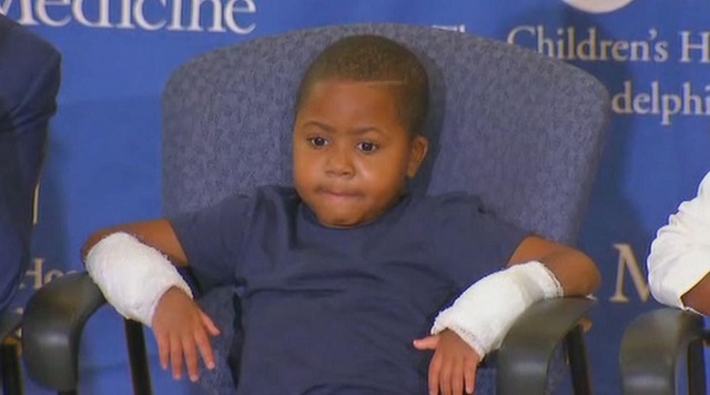 zion harvey, greffe des deux mains