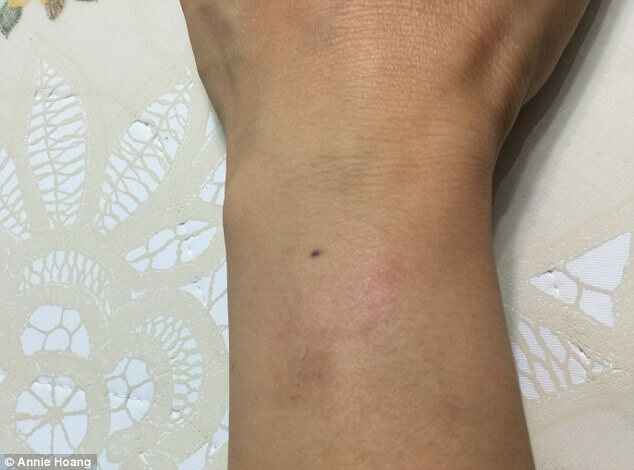 brûlures, Apple Watch