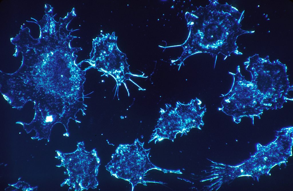 Cancer du sein : des substances polluantes en cause dans le développement de métastases ?