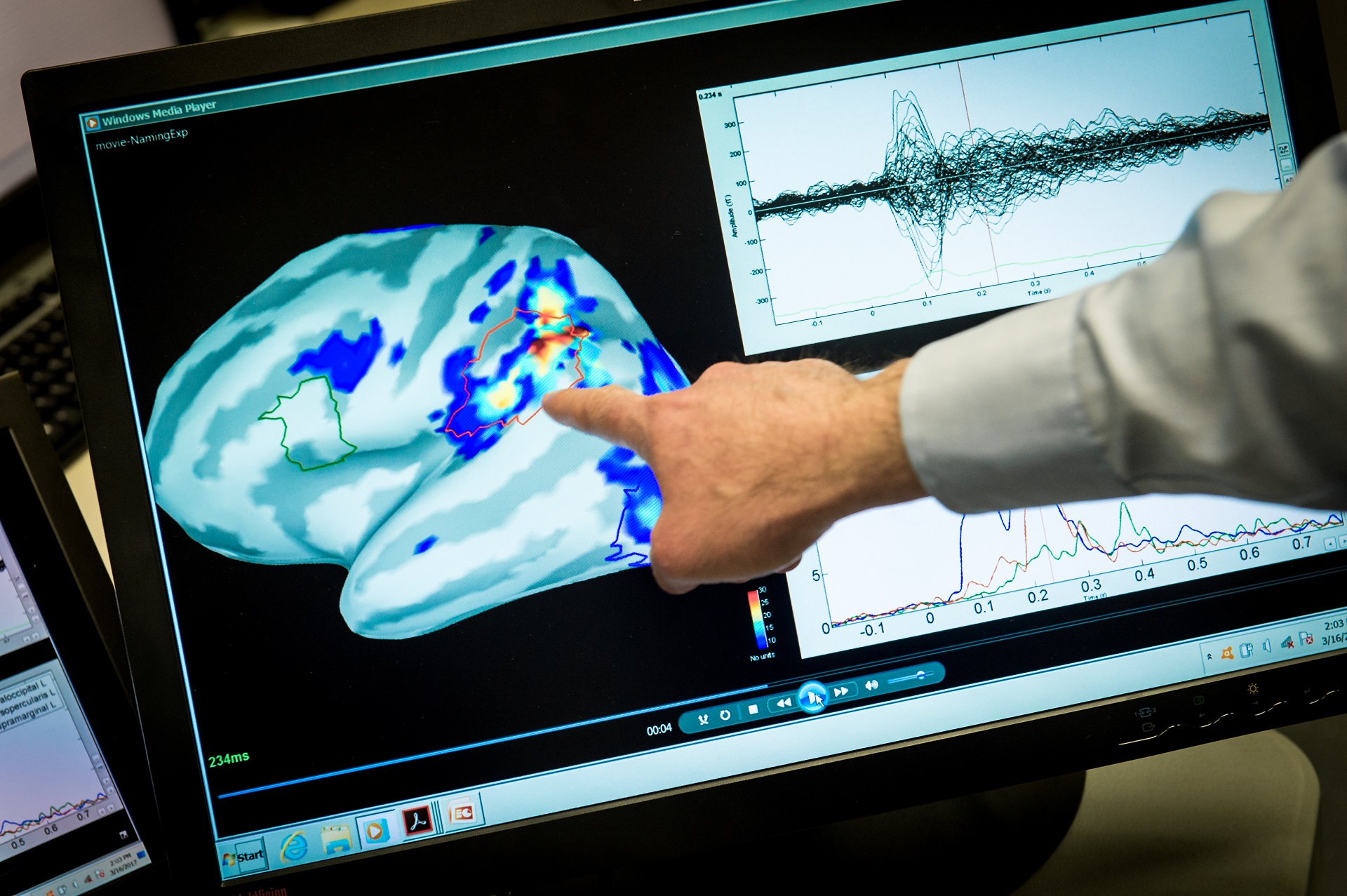 Alzheimer : un test sanguin permet de diagnostiquer la maladie avec 20 ...