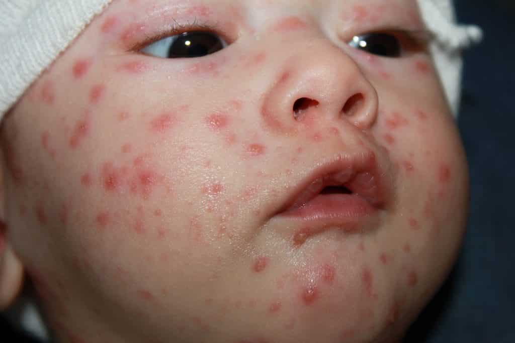 France : une épidémie de varicelle tient en joug la Nouvelle-Aquitaine